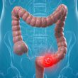 Colorectal Cancer