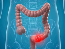 Colorectal Cancer