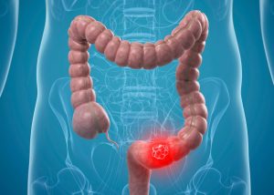 Colorectal Cancer