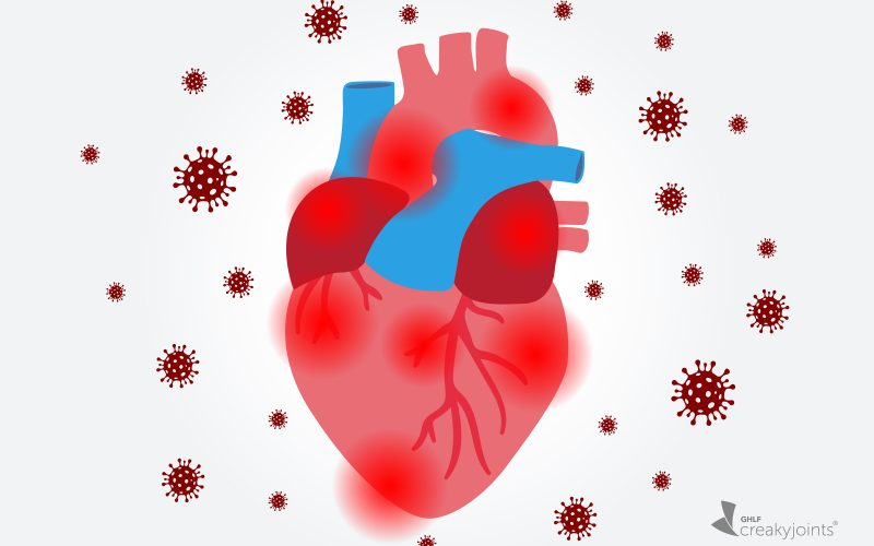 COVID-19 Affects the Heart