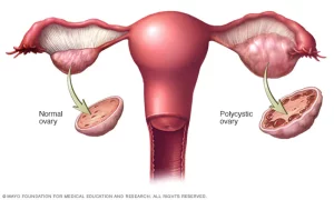 PCOS