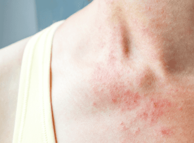 Red Spots