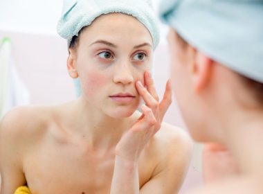 Remedies for Rosacea
