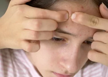 Acne-Free Skin