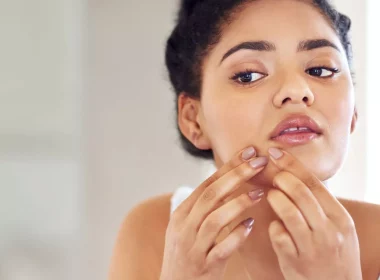 Annoying Chin Blackheads