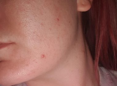 Banish Open Pores