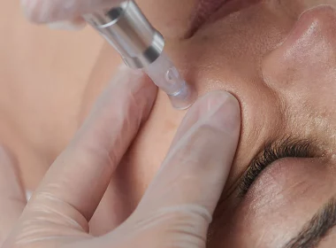 Microneedling Benefits