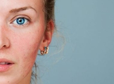 Calming Red Skin