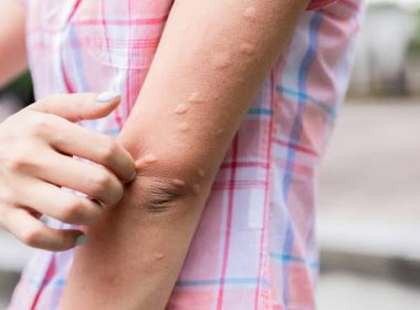 Mosquito Itch