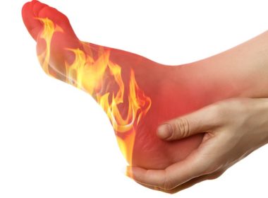 burning feet