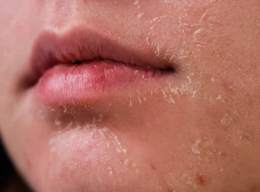 Flake-Free Skin