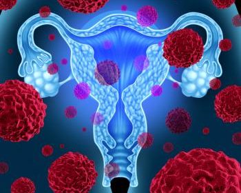 ovarian cancer