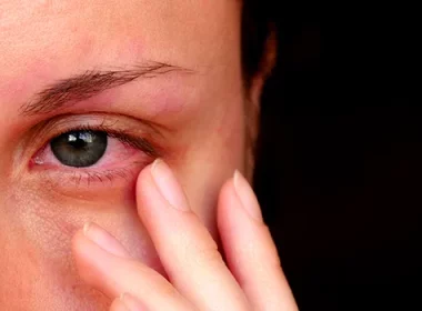 Eye Itchiness