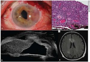 Types of Eye Cancer