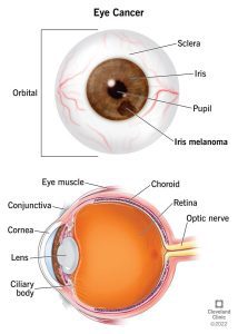 Types of Eye Cancer