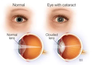 Night Blindness