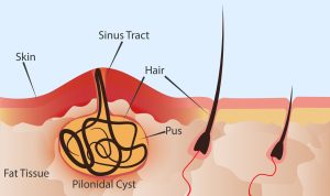  Pilonidal Cysts 