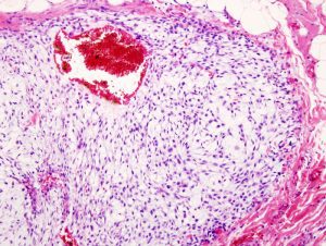 Chondrosarcoma