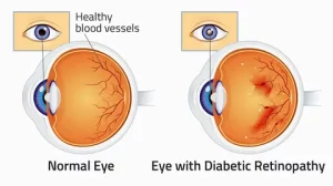 Night Blindness