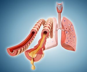 Lung Cancer Complications