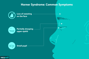 Horner Syndrome