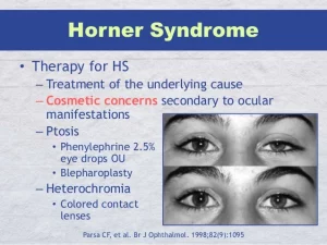  Horner Syndrome