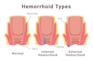 Types of Hemorrhoids