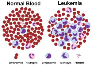 Navigating Leukemia