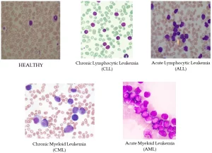 Navigating Leukemia