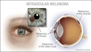 Types of Eye Cancer