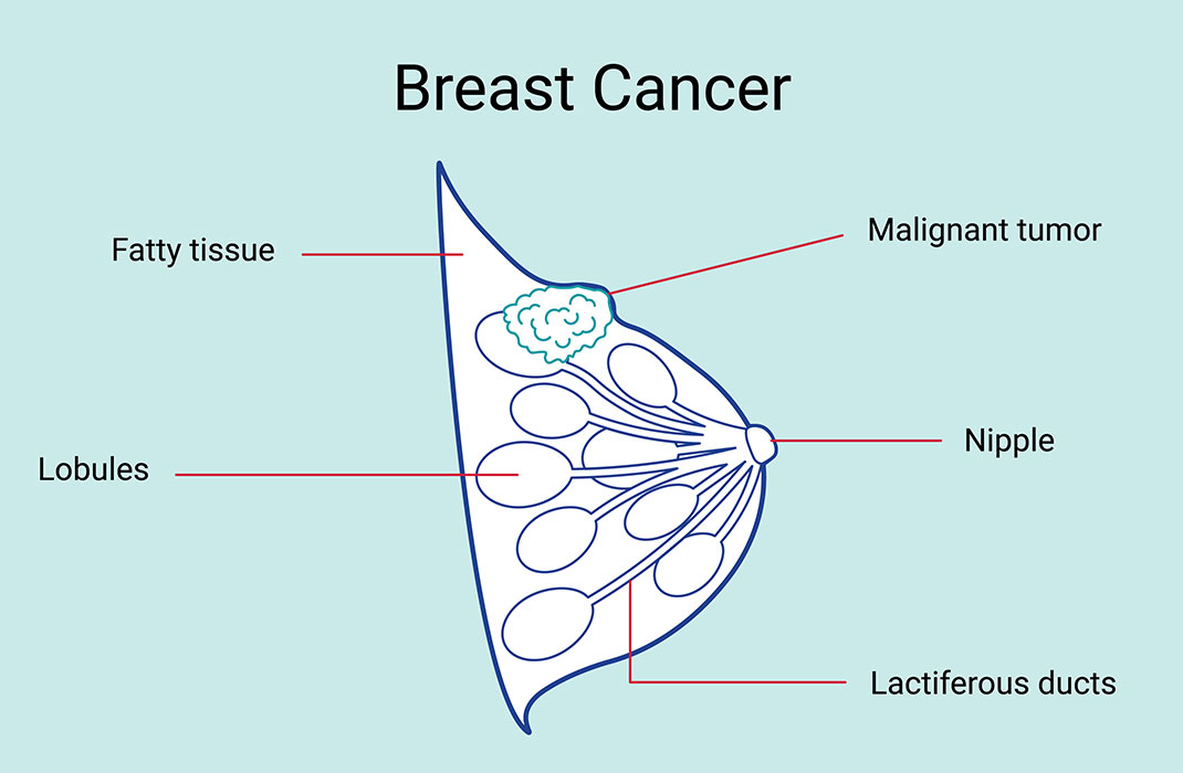 what-does-a-breast-cancer-lump-feel-like