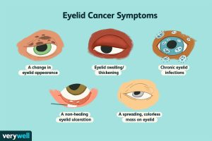 Types of Eye Cancer