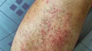 Hair Removal Cause Hives