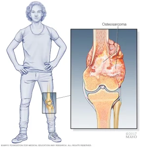 Osteosarcoma