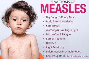 Measles Symptoms