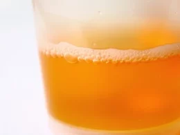 Beer-Like Urine