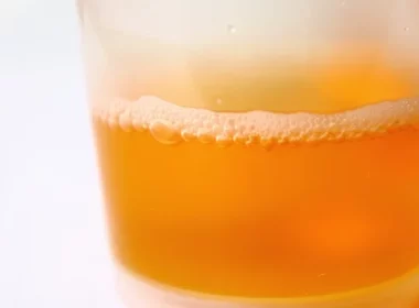 Beer-Like Urine