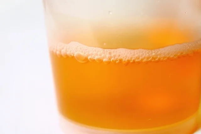 Beer-Like Urine