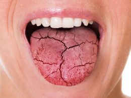 Tongue Cancers