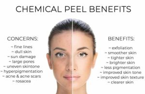 Benefits of Chemical Peels, advance chemical peel treatment, chemical peel treatment for pigmentation 