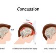 concussion symptoms and signs