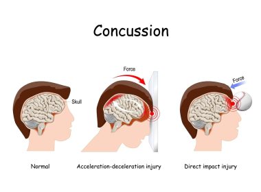 concussion symptoms and signs