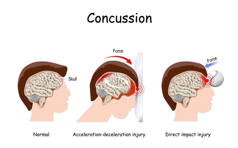 concussion symptoms and signs