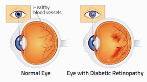 Eye Problems with Aging