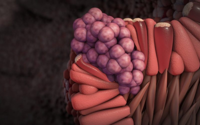 Esophageal Cancer