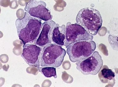 Germ Cell Tumors