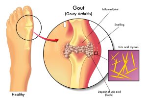 Gout Pain