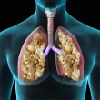 Popcorn Lung