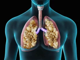 Popcorn Lung