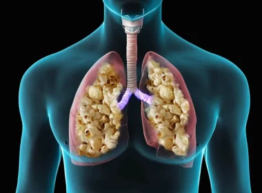 Popcorn Lung